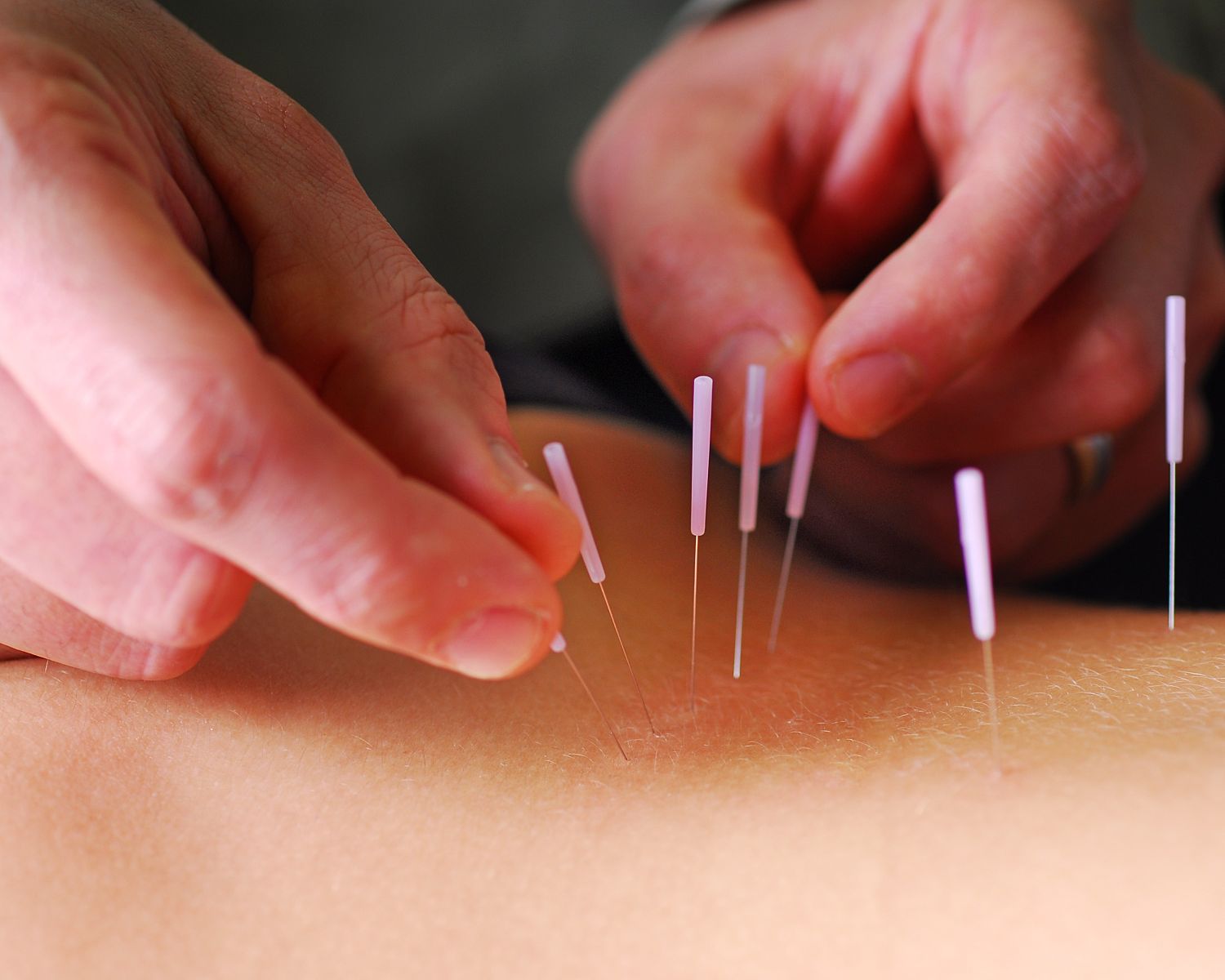 Treloar-physiotherapy-clinic-IMS-dry-needling-acupuncture.
